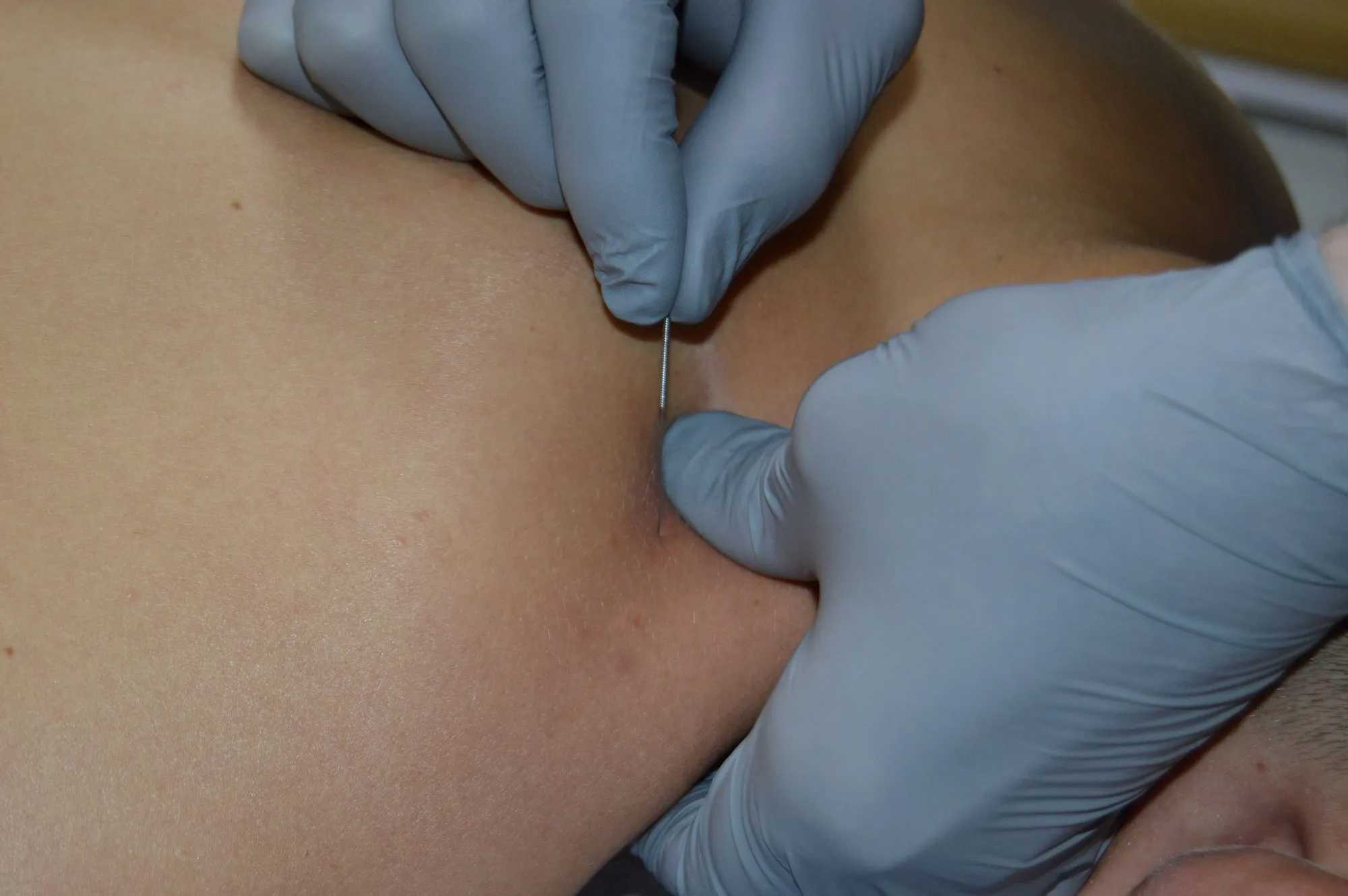 Ac steril de dry needling ținut între degetele înmănușate ale specialistului.